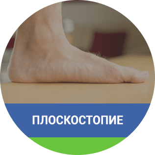 Плоскостопие